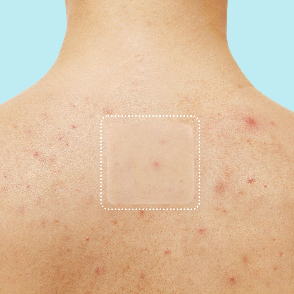 Miracle Patch XL Spot Control Cover S3