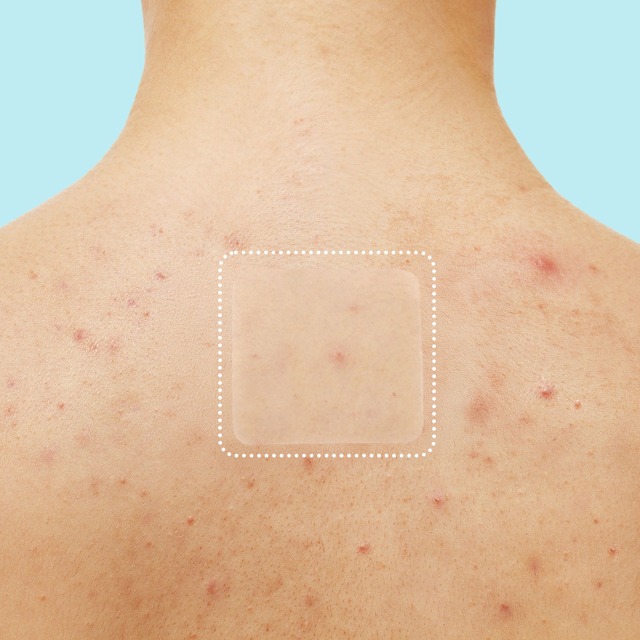 Miracle Patch XL Spot Control Cover S3